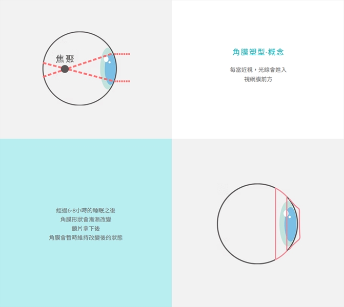 角膜塑型術│角膜塑型推薦眼科診所