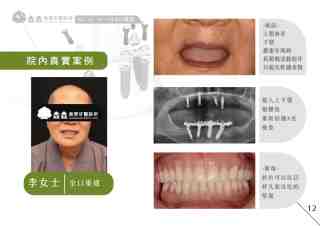 全口重建3&ndash;院內真實案例